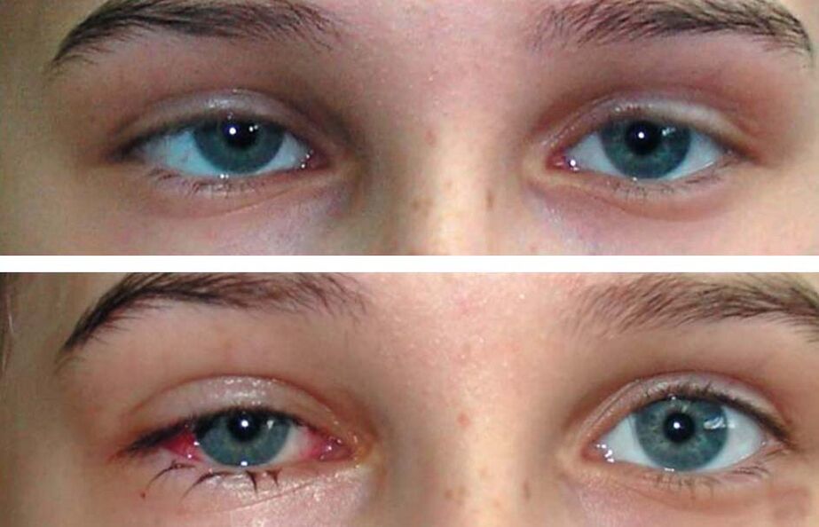 Před a po léčbě Oculax